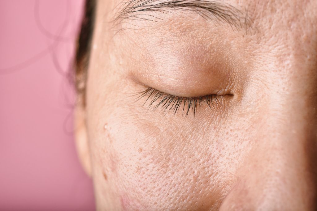 Woman with acne scars